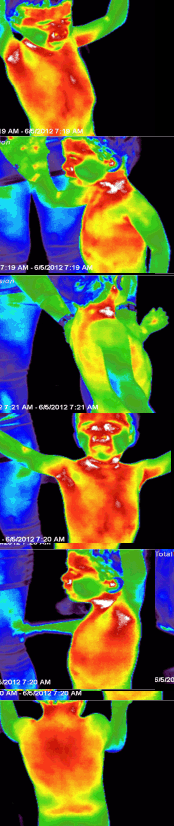 Pre Infrared Images of Child with Autism